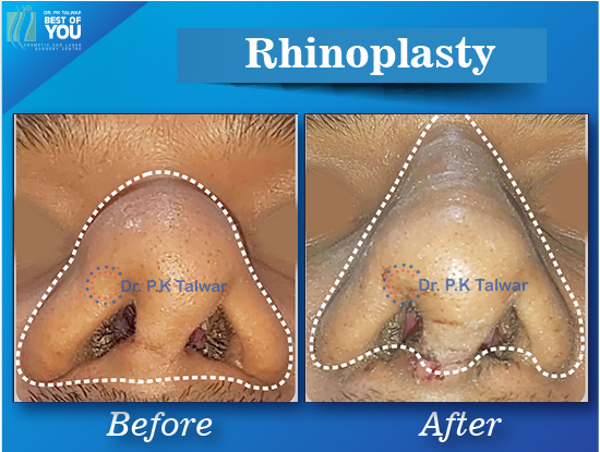 rhinoplasty surgery result